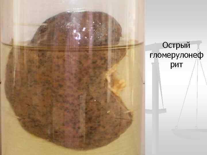 Острый гломерулонеф рит 