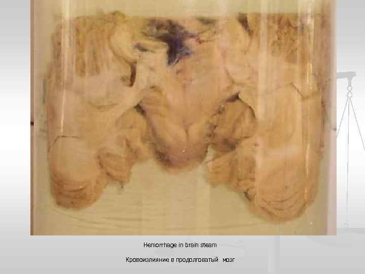 Hemorrhage in brain steam Кровоизлияние в продолговатый мозг 