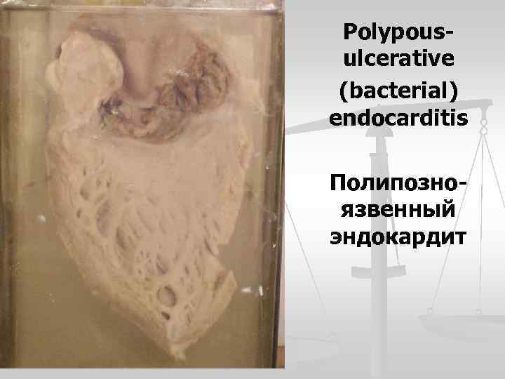 Polypousulcerative (bacterial) endocarditis Полипозноязвенный эндокардит 