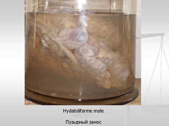 Hydatidiforme mole Пузырный занос 