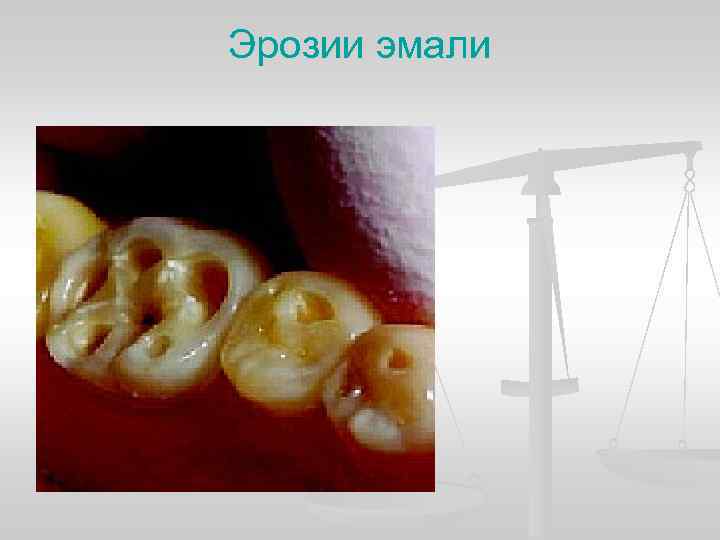 Эрозии эмали 