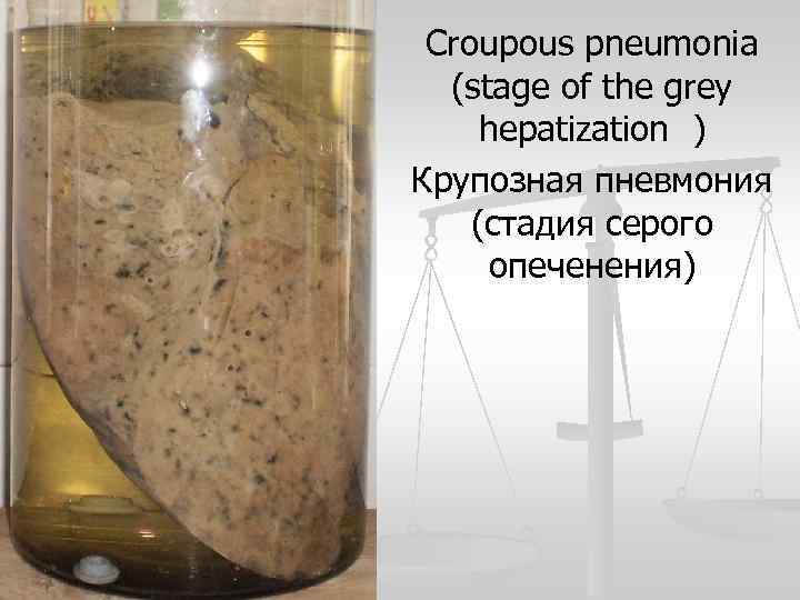 Croupous pneumonia (stage of the grey hepatization ) Крупозная пневмония (стадия серого опеченения) 
