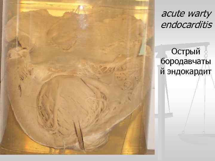 acute warty endocarditis Острый бородавчаты й эндокардит 