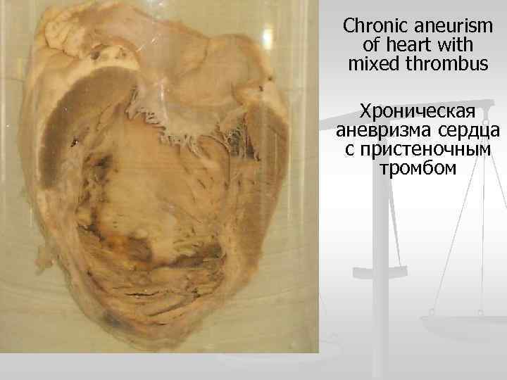 Chronic aneurism of heart with mixed thrombus Хроническая аневризма сердца с пристеночным тромбом 