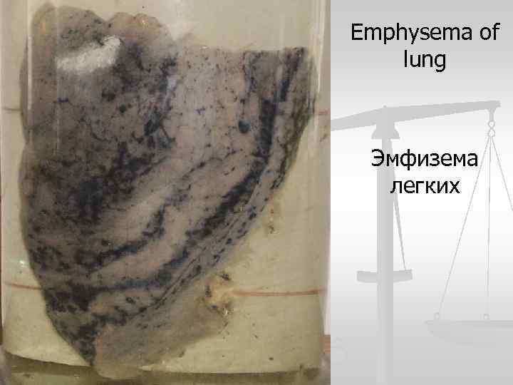 Emphysema of lung Эмфизема легких 