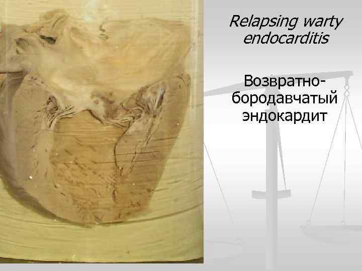 Relapsing warty endocarditis Возвратнобородавчатый эндокардит 