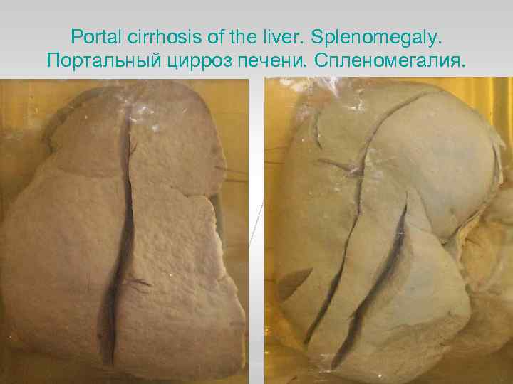 Portal cirrhosis of the liver. Splenomegaly. Портальный цирроз печени. Спленомегалия. 