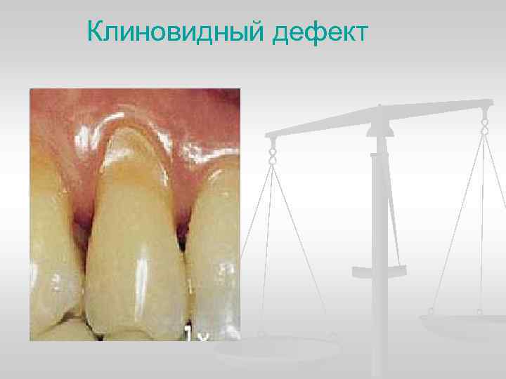 Клиновидный дефект 