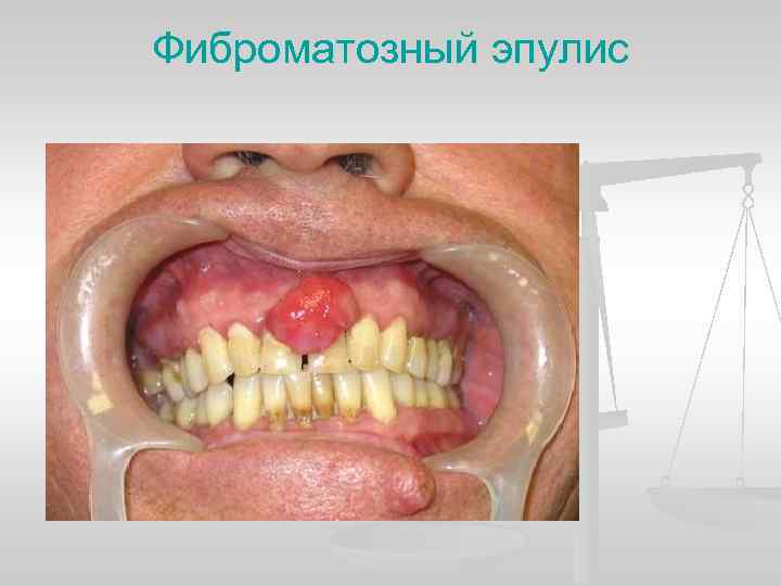 Фиброматозный эпулис 