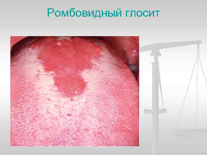 Ромбовидный глосит 