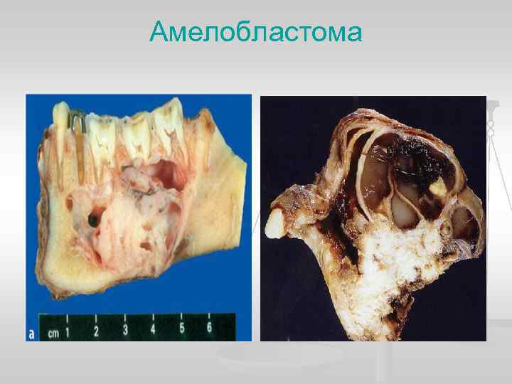 Амелобластома 
