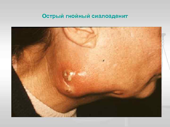 Острый гнойный сиалоаденит 