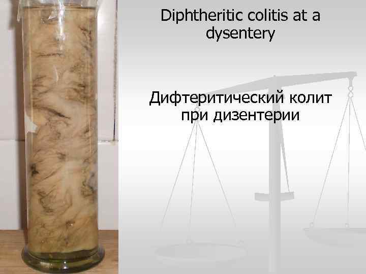 Diphtheritic colitis at a dysentery Дифтеритический колит при дизентерии 