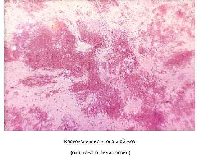 Кровоизлияние в головной мозг (окр. гематоксилин-эозин). 