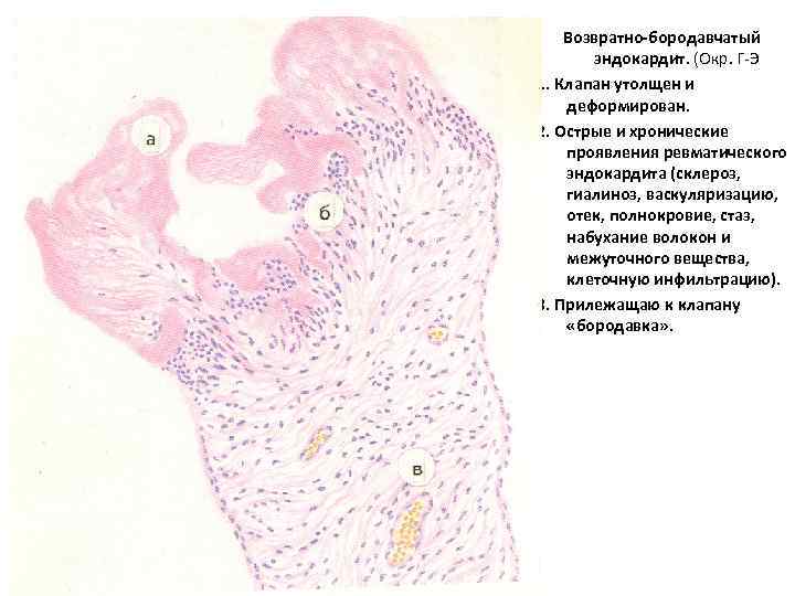 Возвратно-бородавчатый эндокардит. (Окр. Г-Э 1. Клапан утолщен и деформирован. 2. Острые и хронические проявления