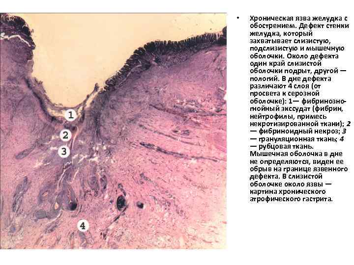  • Хроническая язва желудка с обострением. Дефект стенки желудка, который захватывает слизистую, подслизистую