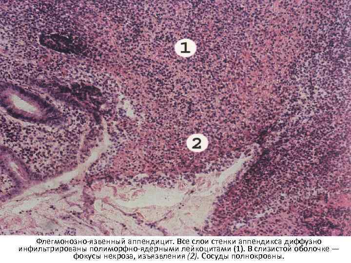 Флегмонозно-язвенный аппендицит. Все слои стенки аппендикса диффузно инфильтрированы полиморфно-ядерными лейкоцитами (1). В слизистой оболочке