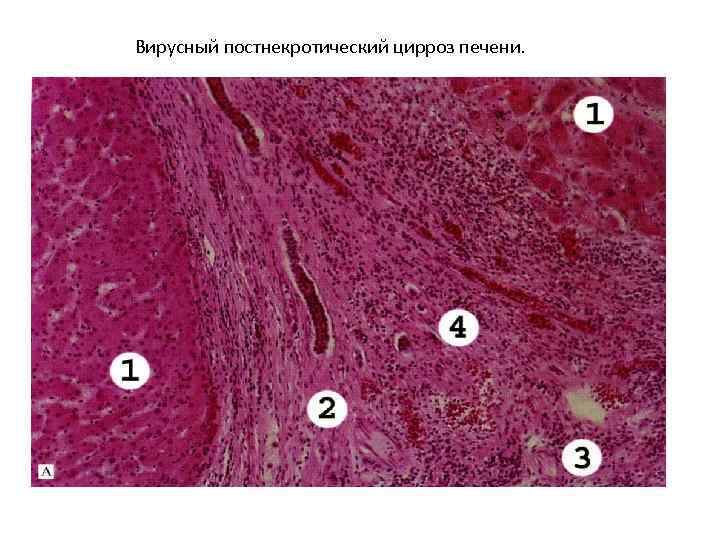 Вирусный постнекротический цирроз печени. 