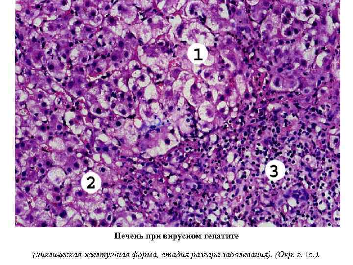 Печень при вирусном гепатите (циклическая желтушная форма, стадия разгара заболевания). (Окр. г. +э. ).