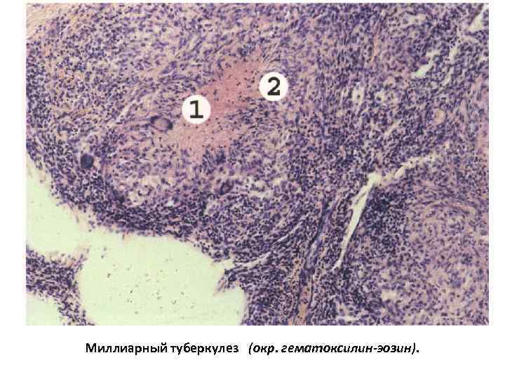 Миллиарный туберкулез (окр. гематоксилин-эозин). 