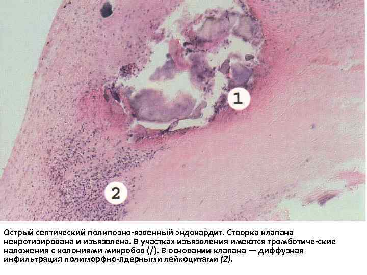 Острый септический полипозно-язвенный эндокардит. Створка клапана некротизирована и изъязвлена. В участках изъязвления имеются тромботиче-ские