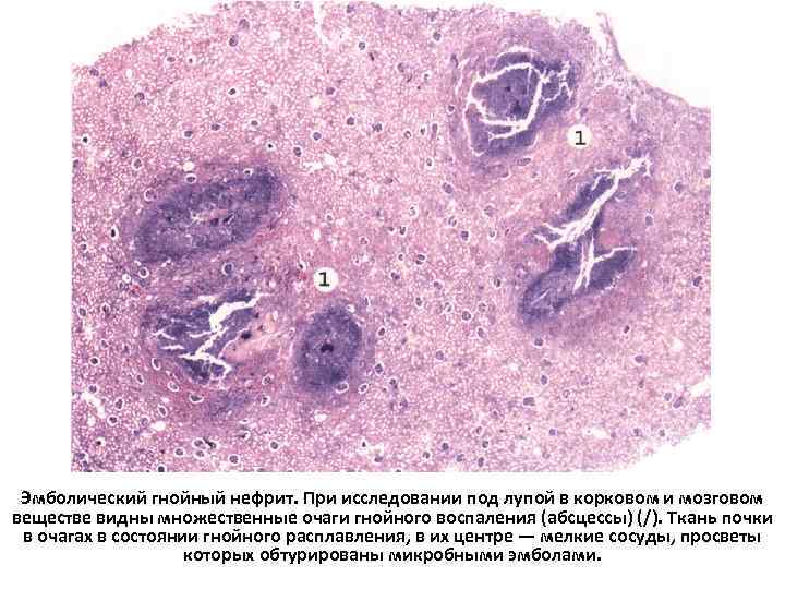 Эмболический гнойный нефрит. При исследовании под лупой в корковом и мозговом веществе видны множественные