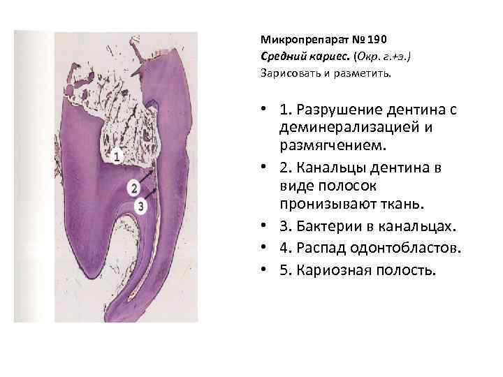 Микропрепарат № 190 Средний кариес. (Окр. г. +э. ) Зарисовать и разметить. • 1.