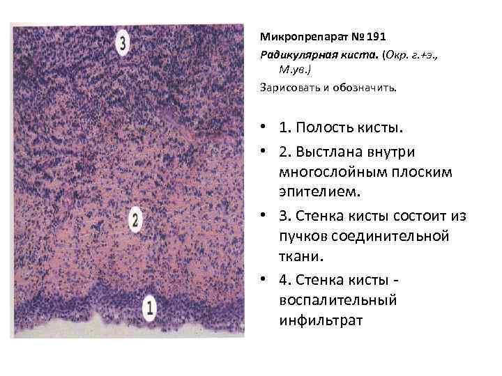 Микропрепарат № 191 Радикулярная киста. (Окр. г. +э. , М. ув. ) Зарисовать и