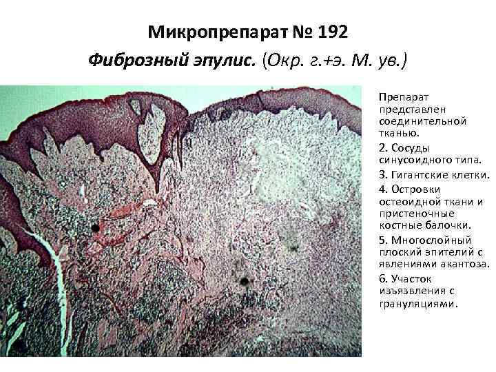 Микропрепарат № 192 Фиброзный эпулис. (Окр. г. +э. М. ув. ) • • •