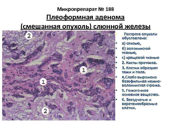 Микропрепарат № 188 Плеоформная аденома (смешанная опухоль) слюнной железы • • • . Пестрота