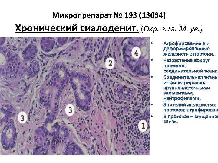 Микропрепарат № 193 (13034) Хронический сиалоденит. (Окр. г. +э. М. ув. ) • •