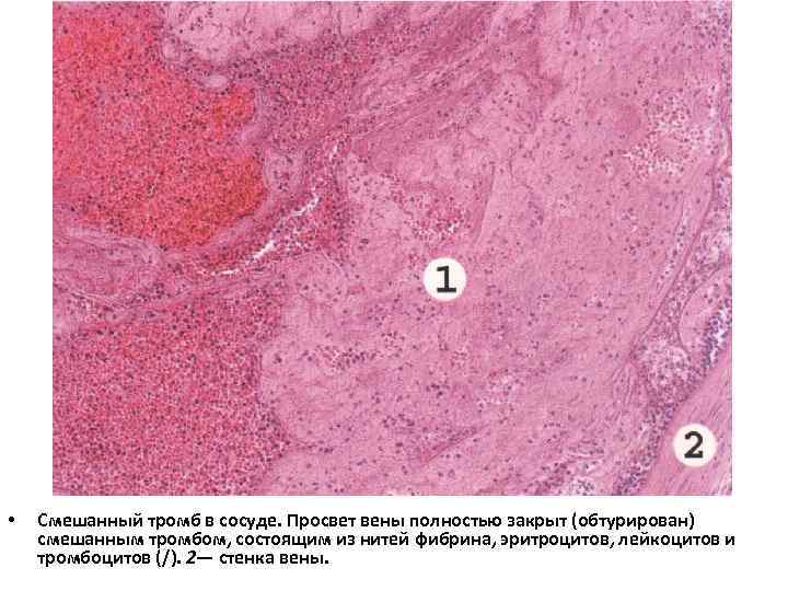  • Смешанный тромб в сосуде. Просвет вены полностью закрыт (обтурирован) смешанным тромбом, состоящим