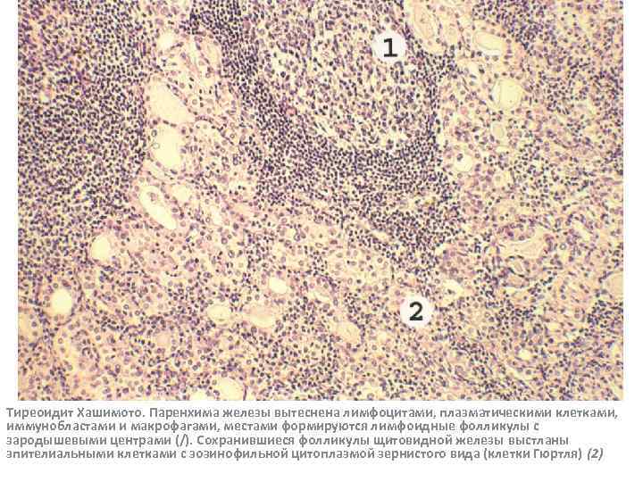 Тиреоидит Хашимото. Паренхима железы вытеснена лимфоцитами, плазматическими клетками, иммунобластами и макрофагами, местами формируются лимфоидные