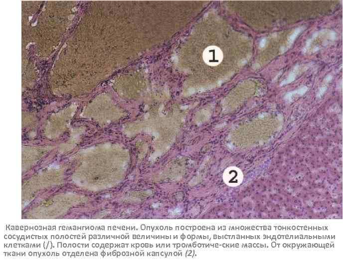 Кавернозная гемангиома печени. Опухоль построена из множества тонкостенных сосудистых полостей различной величины и формы,