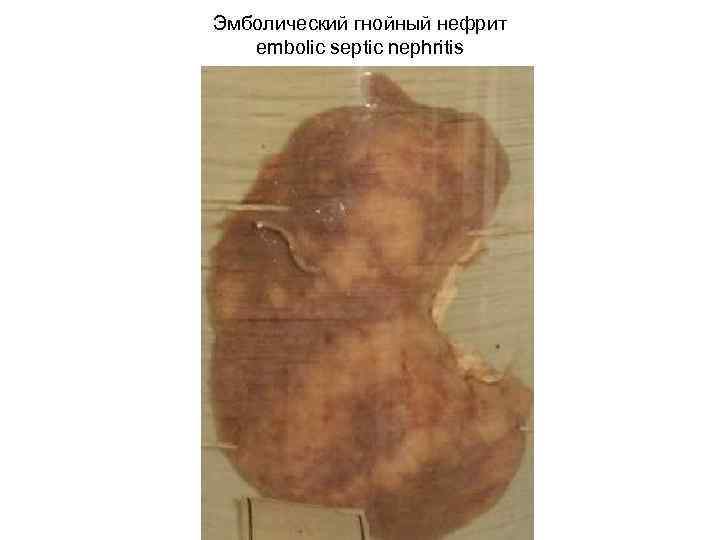 Эмболический гнойный нефрит embolic septic nephritis 