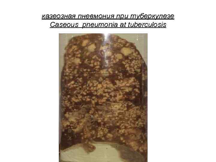 казеозная пневмония при туберкулезе Caseous pneumonia at tuberculosis 