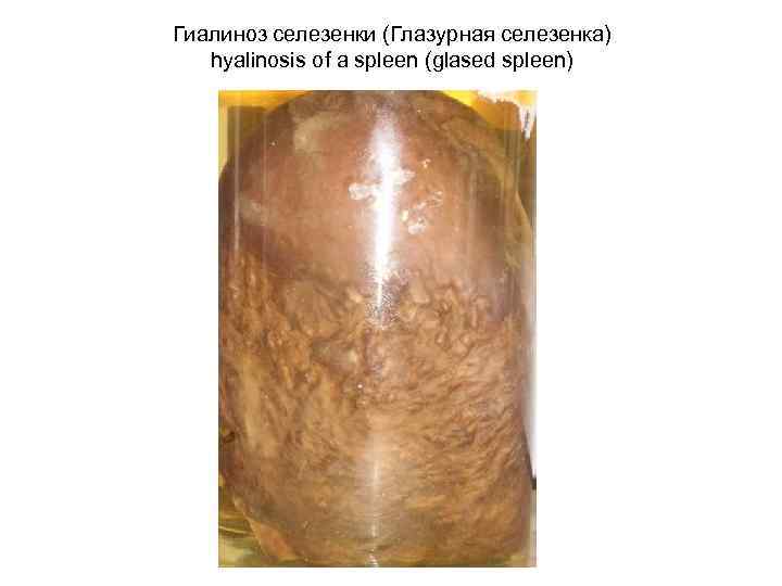 Гиалиноз селезенки (Глазурная селезенка) hyalinosis of a spleen (glased spleen) 