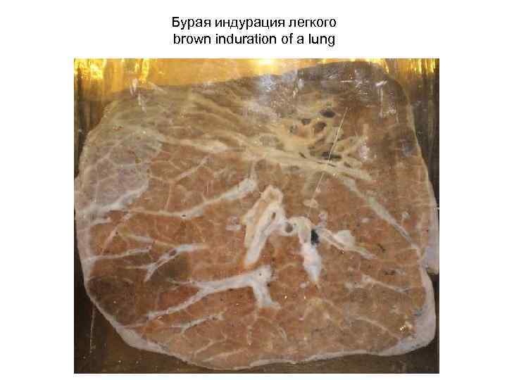 Бурая индурация легкого brown induration of a lung 