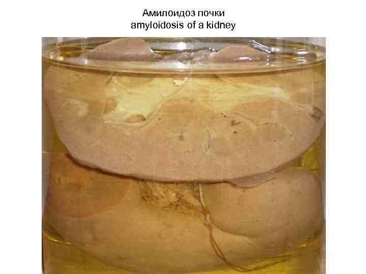 Амилоидоз почки amyloidosis of a kidney 