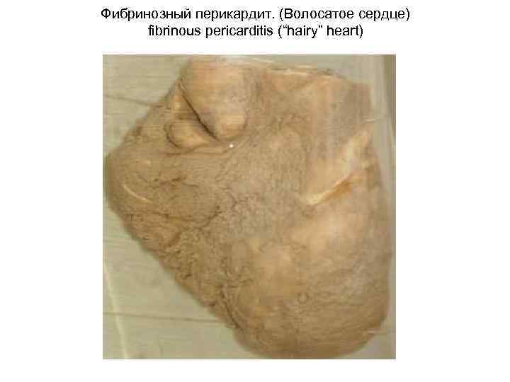 Фибринозный перикардит. (Волосатое сердце) fibrinous pericarditis (“hairy” heart) 