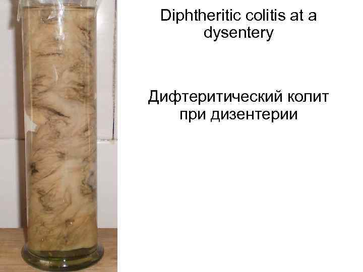 Diphtheritic colitis at a dysentery Дифтеритический колит при дизентерии 