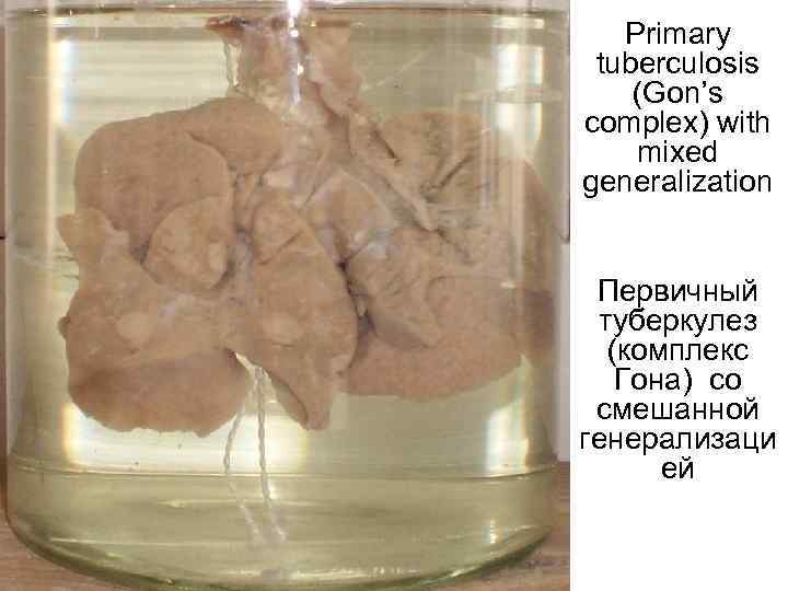Primary tuberculosis (Gon’s complex) with mixed generalization Первичный туберкулез (комплекс Гона) со смешанной генерализаци
