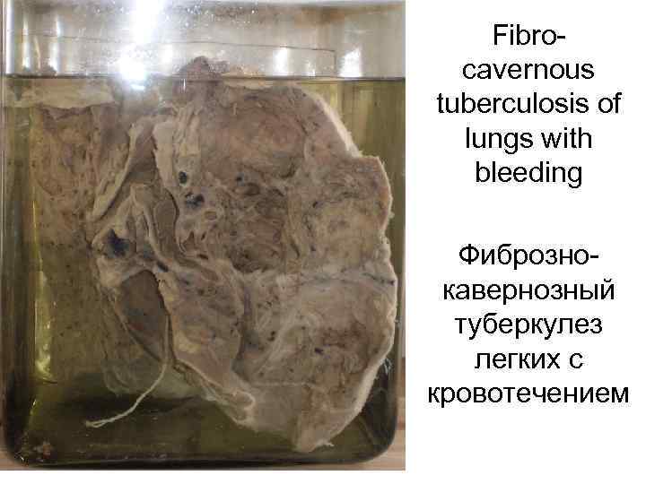 Fibrocavernous tuberculosis of lungs with bleeding Фибрознокавернозный туберкулез легких с кровотечением 