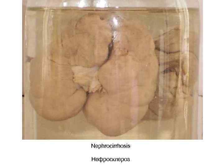 Nephrocirrhosis Нефросклероз 