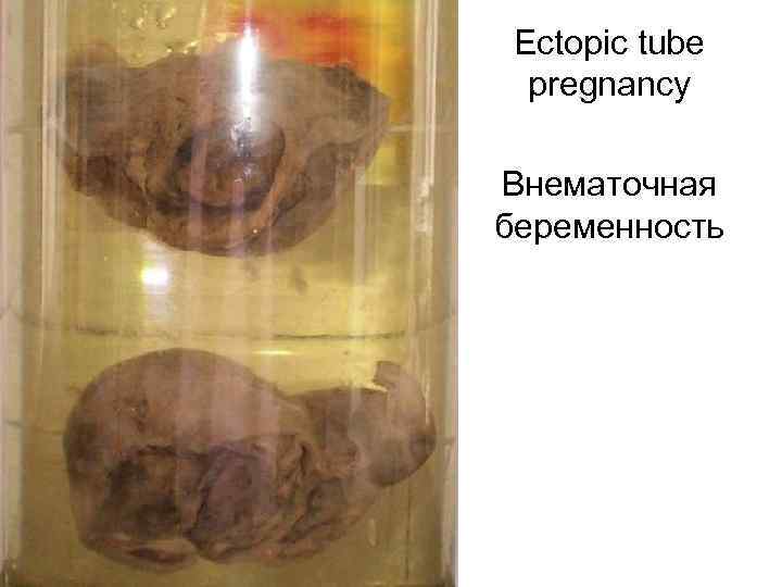 Ectopic tube pregnancy Внематочная беременность 