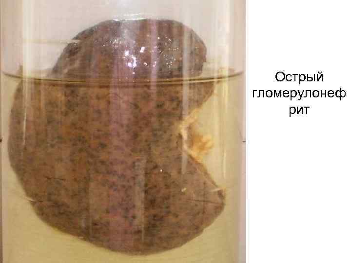 Острый гломерулонеф рит 