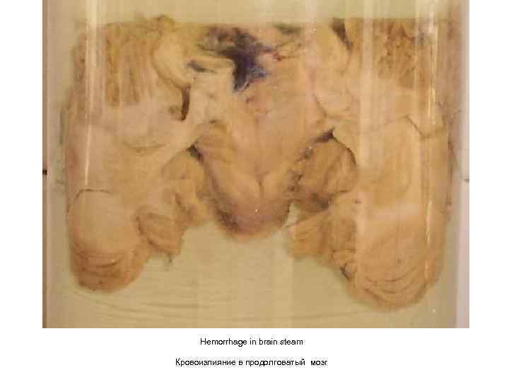 Hemorrhage in brain steam Кровоизлияние в продолговатый мозг 