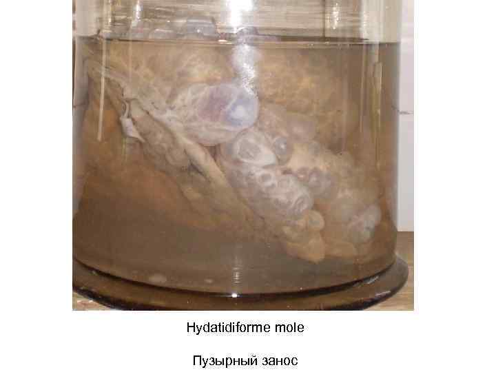 Hydatidiforme mole Пузырный занос 
