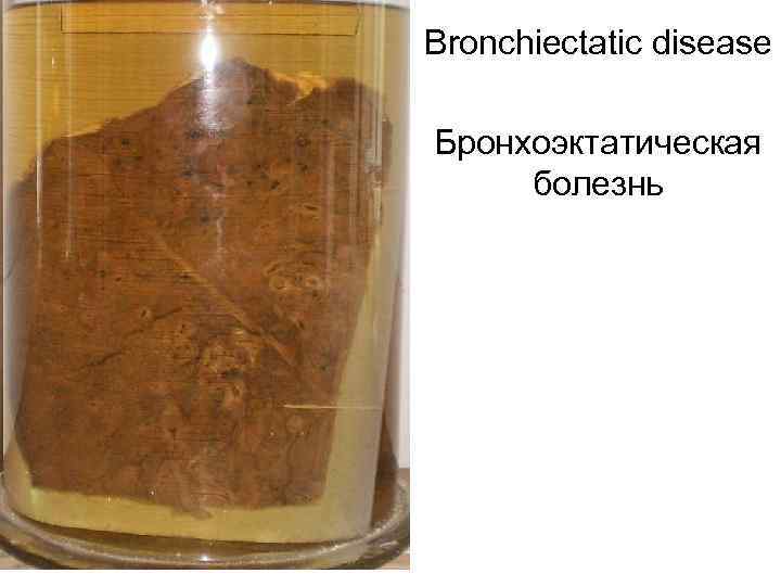 Bronchiectatic disease Бронхоэктатическая болезнь 