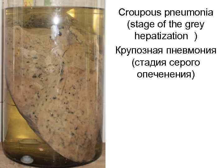 Croupous pneumonia (stage of the grey hepatization ) Крупозная пневмония (стадия серого опеченения) 